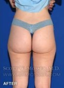 Liposuction - Thighs Patient 68368 After Photo Thumbnail # 4