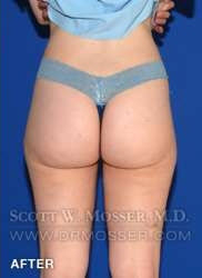 Liposuction - Thighs Patient 68368 After Photo # 4