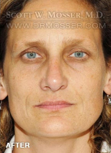 Rhinoplasty Patient 48032 After Photo # 2