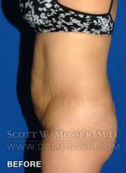 Liposuction - Abdomen & Flanks Patient 30590 Before Photo # 9