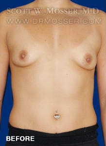 Breast Augmentation Patient 13760 Before Photo # 1