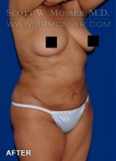 Liposuction - Abdomen & Flanks Patient 39968 After Photo Thumbnail # 6
