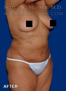 Liposuction - Abdomen & Flanks Patient 39968 After Photo # 6