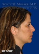 Upper Blepharoplasty Patient 94858 Before Photo Thumbnail # 5