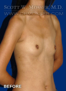 Breast Augmentation Patient 68907 Before Photo # 3