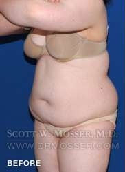 Liposuction - Abdomen & Flanks Patient 26351 Before Photo # 9