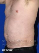 Liposuction - Abdomen & Flanks Patient 64992 Before Photo Thumbnail # 5