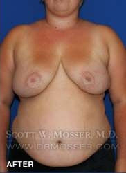Breast Reduction Patient 24410 After Photo # 2