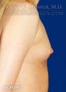 Breast Augmentation Patient 61622 Before Photo Thumbnail # 5