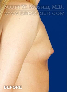 Breast Augmentation Patient 61622 Before Photo # 5