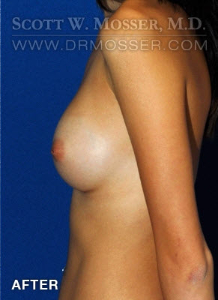 Breast Augmentation Patient 18496 After Photo # 6