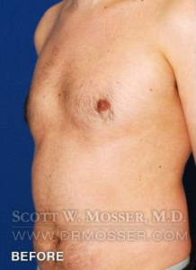 Liposuction - Chest Patient 34240 Before Photo # 5