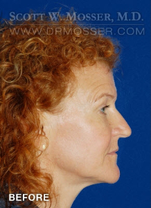 Upper Blepharoplasty Patient 45312 Before Photo # 5