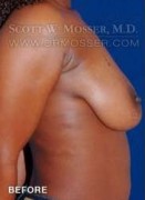 Breast Lift Without Implants Patient 95927 Before Photo Thumbnail # 5