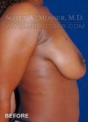 Breast Lift Without Implants Patient 95927 Before Photo # 5