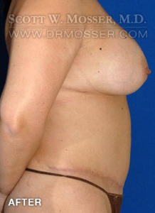 Abdominoplasty Patient 15755 After Photo # 6