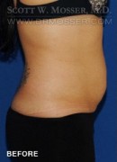 Liposuction - Abdomen & Flanks Patient 25446 Before Photo Thumbnail # 1