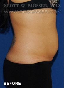 Liposuction - Abdomen & Flanks Patient 25446 Before Photo # 1