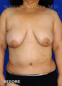 Breast Reduction Patient 54296 Before Photo # 1