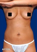 Liposuction - Abdomen & Flanks Patient 53811 After Photo Thumbnail # 2