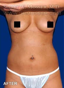 Liposuction - Abdomen & Flanks Patient 53811 After Photo # 2