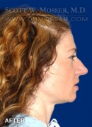 Upper Blepharoplasty Patient 26830 After Photo Thumbnail # 6