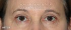 Lower Blepharoplasty Patient 38290 After Photo Thumbnail # 2