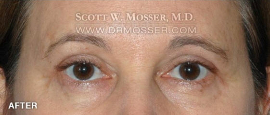 Lower Blepharoplasty Patient 38290 After Photo # 2