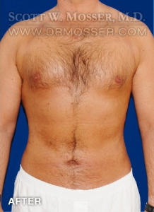 Liposuction - Chest Patient 51212 After Photo # 2
