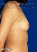 Breast Augmentation Patient 85660 Before Photo Thumbnail # 5