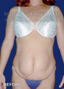 Abdominoplasty Patient 49869 Before Photo Thumbnail # 1