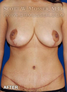 Mommy Makeover Patient 60933 After Photo # 2
