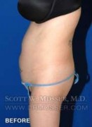 Liposuction - Abdomen & Flanks Patient 81638 Before Photo Thumbnail # 9