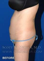 Liposuction - Abdomen & Flanks Patient 81638 Before Photo # 9