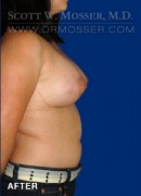 Breast Augmentation Patient 59926 After Photo Thumbnail # 6