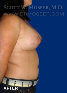 Breast Augmentation Patient 59926 After Photo # 6