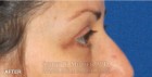 Lower Blepharoplasty Patient 88372 After Photo Thumbnail # 6