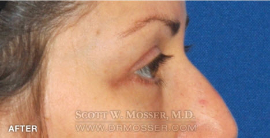 Lower Blepharoplasty Patient 88372 After Photo # 6