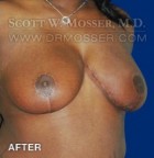 Breast Reduction Patient 70589 After Photo Thumbnail # 4