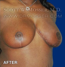 Breast Reduction Patient 70589 After Photo # 4