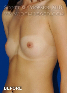 Breast Augmentation Patient 18496 Before Photo # 3