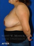 Breast Reduction Patient 27332 After Photo Thumbnail # 8