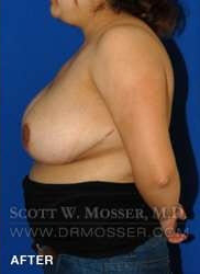 Breast Reduction Patient 27332 After Photo # 8