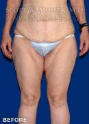 Thigh Lift Patient 28030 Before Photo Thumbnail # 1