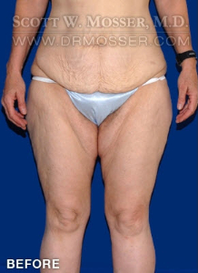 Thigh Lift Patient 28030 Before Photo # 1