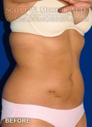 Liposuction - Abdomen & Flanks Patient 95887 Before Photo Thumbnail # 3