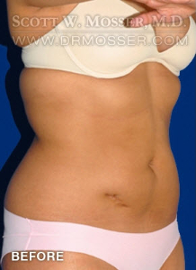 Liposuction - Abdomen & Flanks Patient 95887 Before Photo # 3