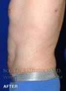 Liposuction - Abdomen & Flanks Patient 64992 After Photo Thumbnail # 10