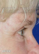 Upper Blepharoplasty Patient 93893 After Photo Thumbnail # 6