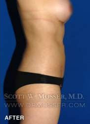 Liposuction - Abdomen & Flanks Patient 58519 After Photo # 8